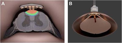 Intradural Spinal Cord Stimulation: Performance Modeling of a New Modality